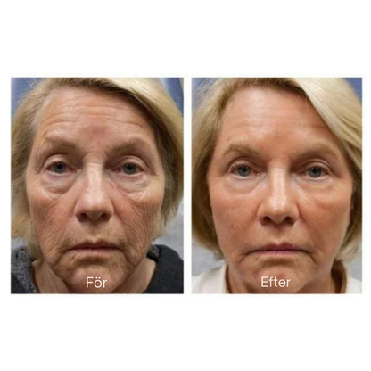 AntiRynk™ | Botox Rynkborttagningskräm