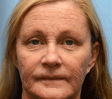 AntiRynk™ | Botox Rynkborttagningskräm