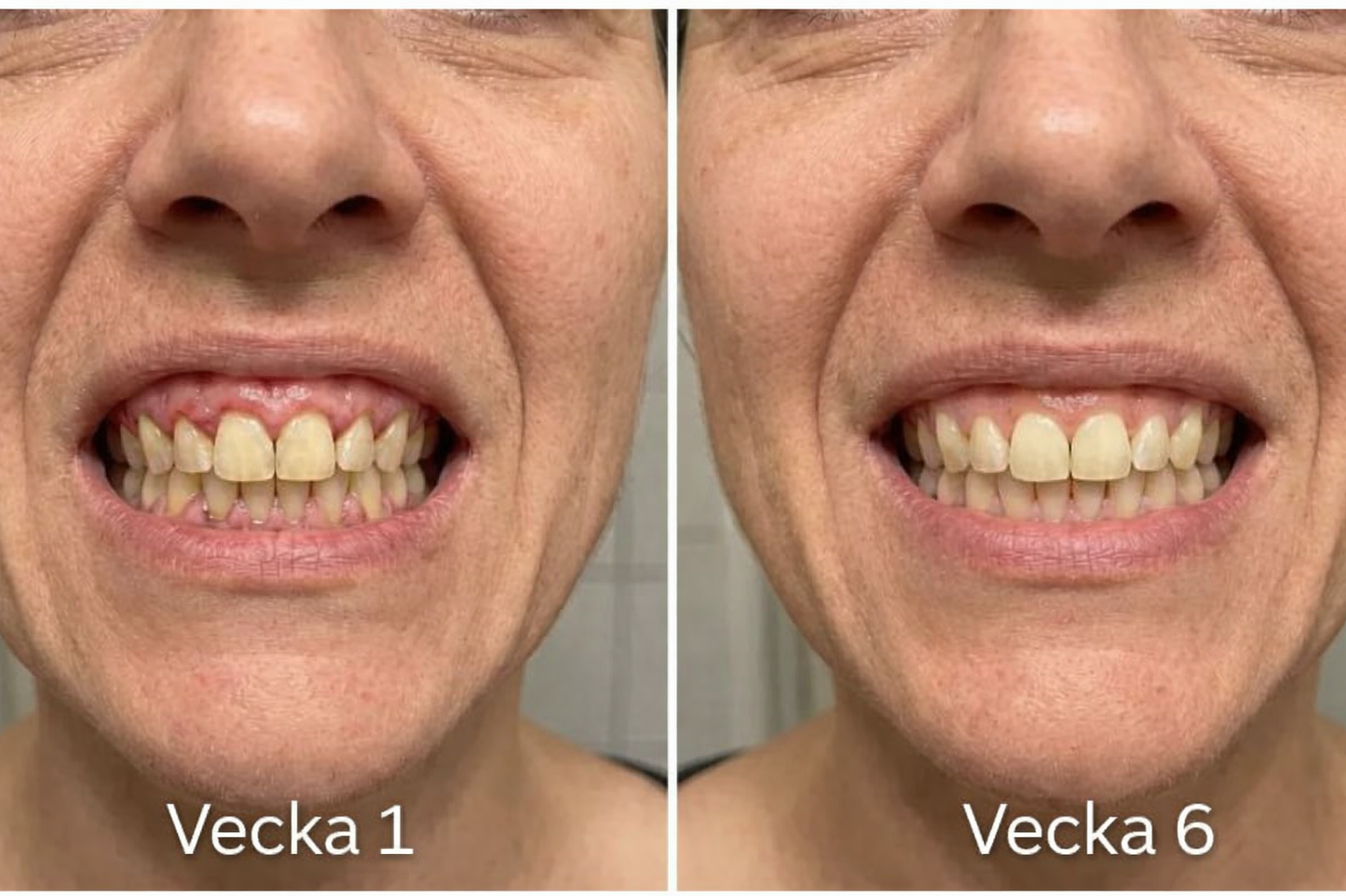NordSmile™ | Fixeringsspray för tandkött | NordVea