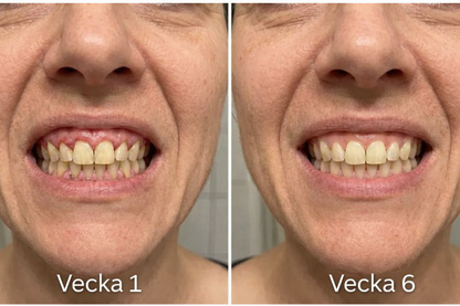 NordSmile™ | Fixeringsspray för tandkött | NordVea